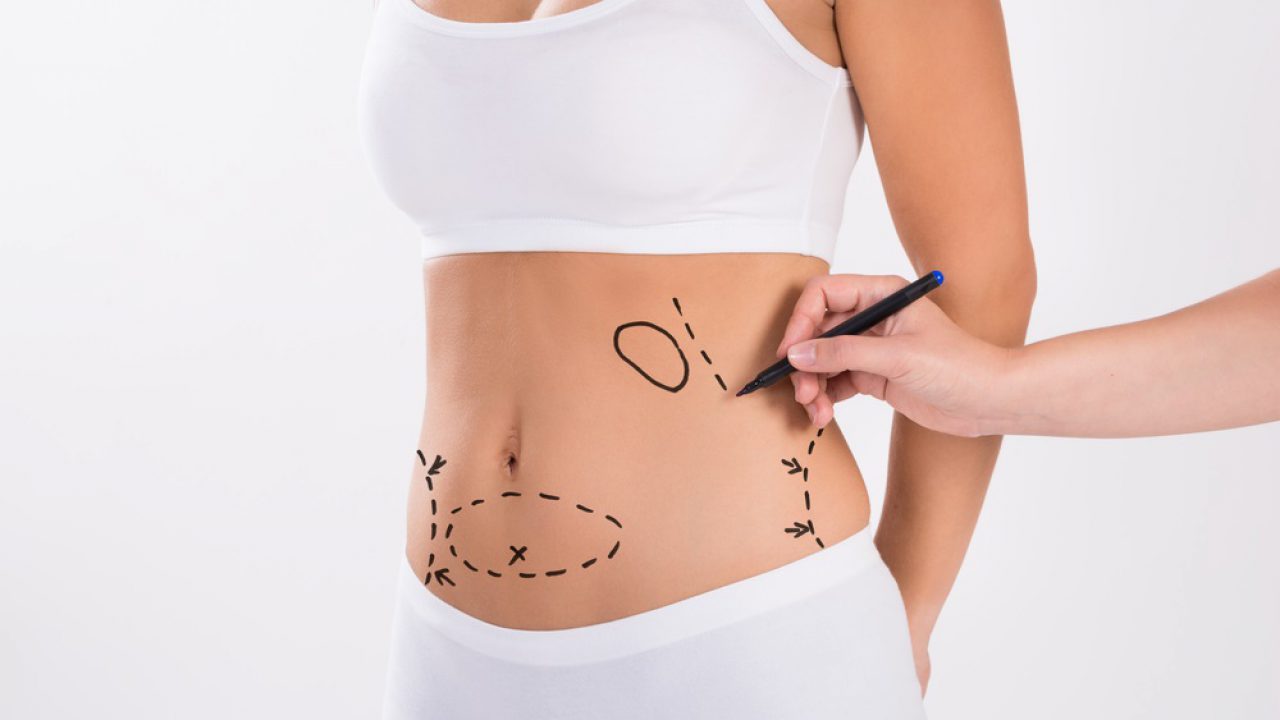 Bölgesel Yağlanmalarınızdan Liposuction ile Kurtulun